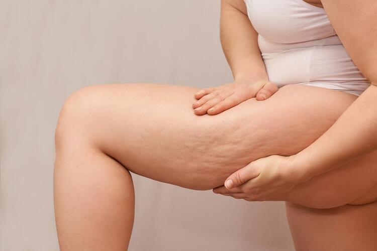 What is cellulite? What products are recommended to use against cellulite?