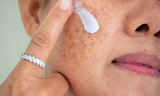 How do you treat the spots?!