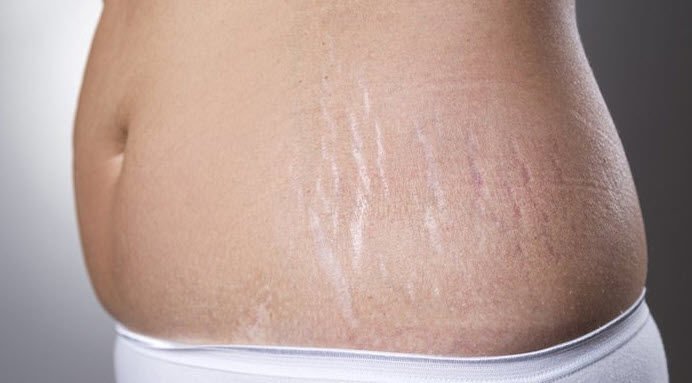 How to treat postpartum stretch marks?