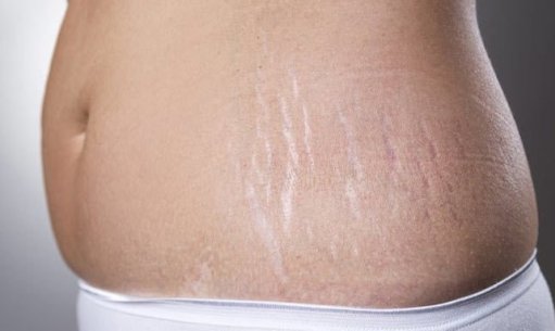 How to treat postpartum stretch marks?