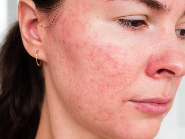 Don't Do These If You Have Sensitive Skin - Care Tips  for sensitive skin