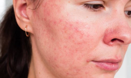 Don't Do These If You Have Sensitive Skin - Care Tips  for sensitive skin